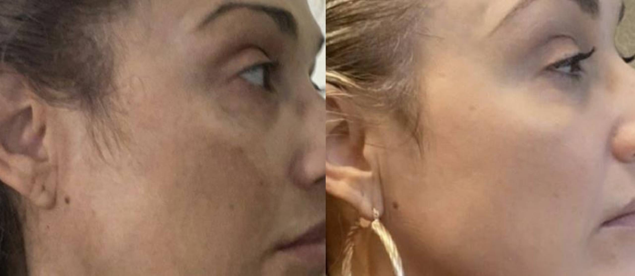 Melasma - Skin Care Aesthetics in Baytown, TX Melasma - Skin Care Aesthetics in Baytown, TX