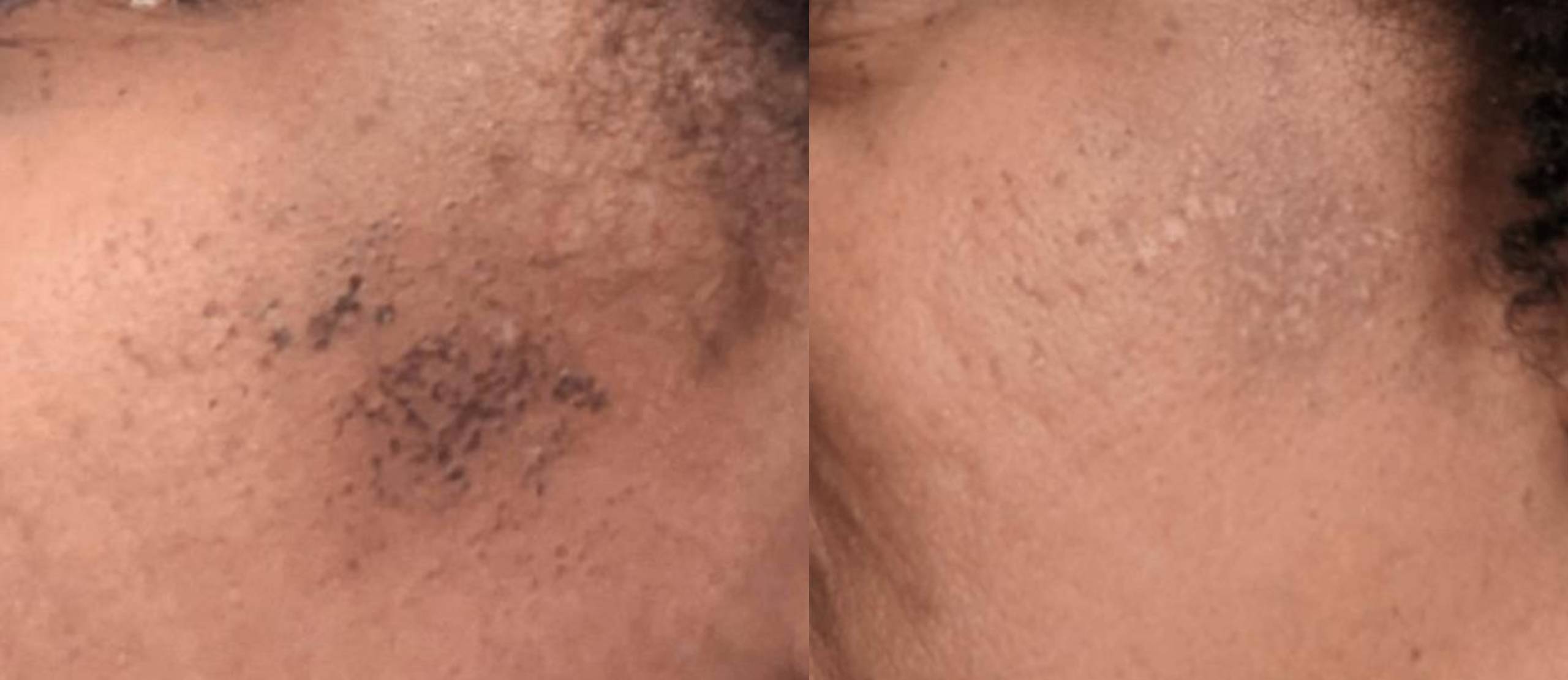 Melasma - Skin Care Aesthetics in Baytown, TX Melasma - Skin Care Aesthetics in Baytown, TX
